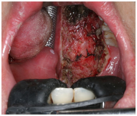 Figure 4 Immediate postoperative view of the surgical defect after robotic radial tonsillectomy.