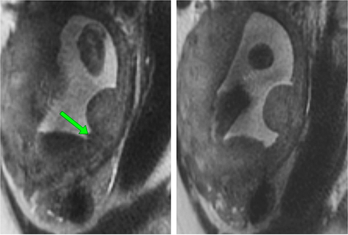 Figure 2 (A) Magnetic resonance serial sagittal T2 sections at the level of the uterus. Arrow – band of placental parenchyma between the placenta and the accessory lobe. (B) Magnetic resonance serial sagittal T2 sections at the level of the uterus - The maximum distance between main placental mass and the accessory lobe.