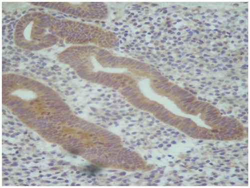 Figure 1 Aromatase expression in the eutopic endometrium detected by immunohistochemistry.