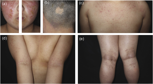 Figure 1 Clinical photographs at baseline. Extensive symmetrical red patches and papules with crusts and scales were observed on the patient’s (a) face, (c) trunk, and (d and e) extremities. (b) The occipital scalp showed a coin-sized patch of hair loss.
