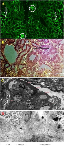 Figure 1. (case 1): (A) Segmental lambda positivity of the tubular and glomerular basement membrane (100×) (B) Congo red stain - apple green birefringence under polarized microscopy - segmental glomerular and tubular basement membrane positivity (200×) (C) Electron microscopy, peripheral glomerular capillary segment, low magnification (4000×). Nodular mesangial expansion with diabetic fibrillosis (white triangle) and thickened glomerular basement membrane measuring 1200 nm (white arrow). The urine space is narrow with extensive podocyte foot process effacement (white star) (D) Electron microscopy, tubular basement membrane. Three different types of partially organized fibrillary structures in and around the tubular basement membrane. Collagen fibers’ diameter ∼30 nm (black star), amyloid fibers’ diameter ∼10–12nm (white arrow) and diabetic fibrillosis like structures’ diameter ∼10 nm (black arrow).