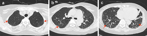 Figure 2 Chest computed tomography scans of PJP. (a–c) stripe shadows (red arrow) in bilateral lungs.