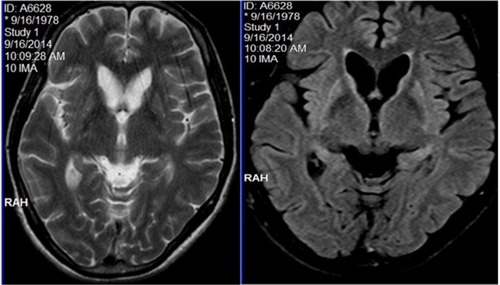 Figure 3 MRI showing caudate atrophy and striatal hyperintensities in both T2WI and FLAIR sequences.