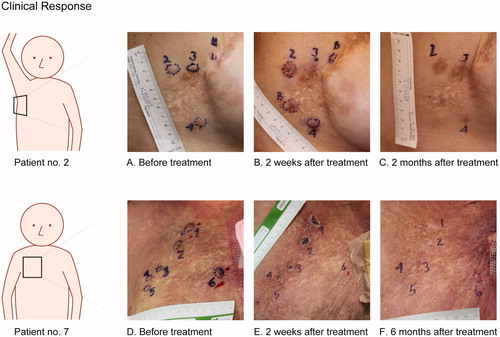 Figure 4. The top row show pictures from patient no. 2 with cutaneous metastases from breast cancer. Metastases 2 and 3 were treated with bleomycin and electroporation, metastasis 4 were treated with calcium and electroporation. The two metastases labeled B were treated with bleomycin outside of protocol. A. before treatment. B. Two weeks after treatment, shows crust on metastases no. 2, disappearing of metastases no. 3, and no visible chance in metastasis no. 4. C. Two months after treatment, show clear hyperpigmentation equivalent to the area treated with bleomycin (metastases no. 2 and 3) and no change in pigmentation in the area treated with calcium (metastases no. 4). Bottom row show pictures from patient no. 7 with cutaneous metastases from breast cancer. Metastases 1–3 were treated with bleomycin and electroporation and metastases 4–6 were treated with calcium and electroporation. D. before treatment. E. Two weeks after treatment, illustrates typical crust appearance, note the ulcer is not extending tumor margin. F. Six months after treatment, shows complete disappearance of metastases 1–5 and no change in metastasis no. 6.