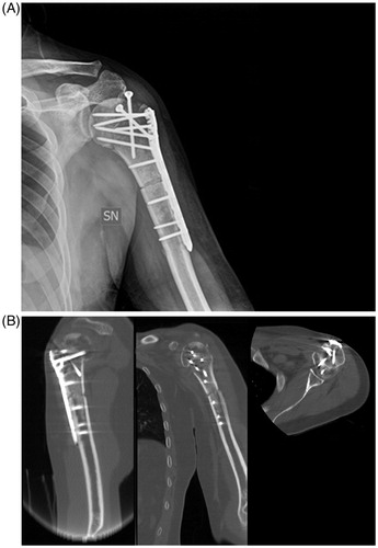 Figure 5. (A) Postoperative X-ray showing the reconstruction with homograft, plate and screws; (B) postoperative CT-scan.