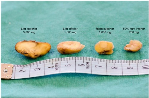 Figure 6 Patient’s parathyroid glands.