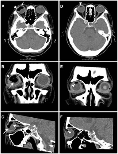 Figure 2 CT scans showing the presence of suprachoroidal gas. (A–C) On postoperative Day 7, two separate low-density areas of suprachoroidal gas (arrows) and intravitreal gas (arrowheads) are seen. (D–F) On postoperative Day 14, the intravitreal gas has resolved and a small amount of residual suprachoroidal gas is seen (arrowheads).
