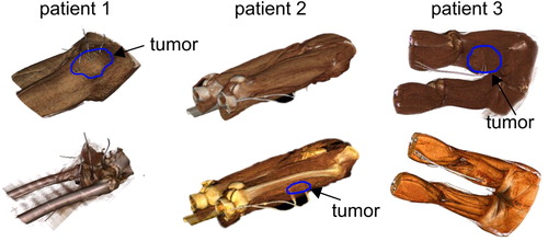 Figure 1. 3D volume rendering of three exemplary STS patients with implemented catheters in the tumor.