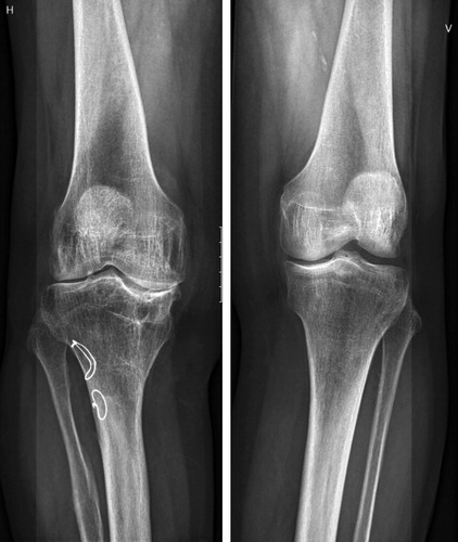 Figure 2 c. Radiographs at 65 years follow-up, showing moderate osteoarthritis of the right knee.