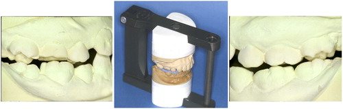 Figure 4. Bite registration was taken at MTCP and mounted in Terminus Articulator. Posterior occlusal discrepancy of 2–3 mm is obvious at MTCP.