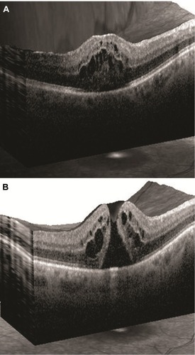 Figure 1 (A) Patient OCT scan depicting cystoid macular edema. (B) Patient OCT scan depicting cystoid macular edema and full-thickness macular hole (Grade IV).