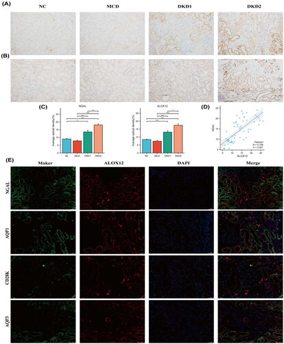 Figure 5. Expression of ALOX12 protein in human kidney tissue. (A) IHC detection of NGAL protein expression in human kidney tissue. (B) IHC detection of ALOX12 protein expression in human kidney tissue. (C) Expression results of ALOX12 levels and NGAL levels. (D) Correlation analysis of ALOX12 levels with NGAL levels. (E) IF double staining of ALOX12 and specific tubular markers in renal biopsy tissues of patients with DKD. Scale bar = 50 μm. *p < .05, **p < .01, and ***p < .001.