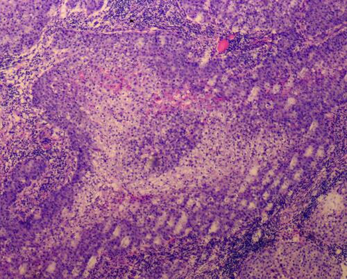 Figure 2 Basaloid neoplasm in lobules and sebaceous cells with vacuolated cytoplasm in the dermis (hematoxylin and eosin; magnification: 10×10).
