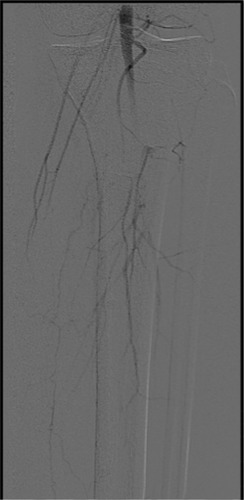 Figure 4 AP image from digital subtraction left lower extremity arteriogram demonstrates thrombosis of the majority of the proximal runoff vessels.