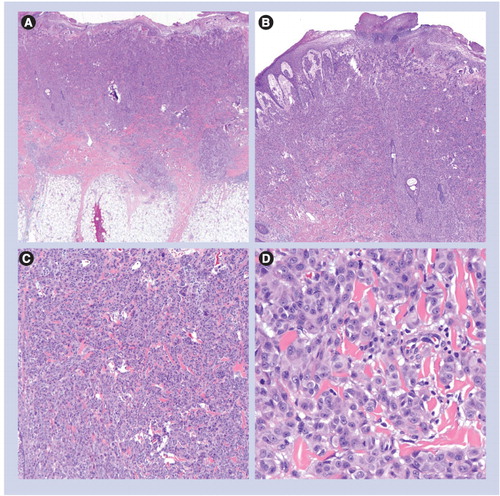 Figure 7. Spitzoid melanoma.(A) Expansile dermal tumor with surface ulceration (20×). (B & C) Sheet-like growth pattern (40× and 100×, respectively). (D) Epithelioid melanocytes with nuclear pleomorphism, prominent nucleoli and mitoses (400×).