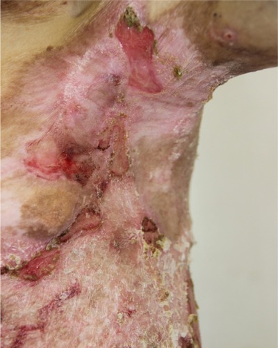 Figure 10 Appearance of lesions on the patients axilla on day 1 after discharge.