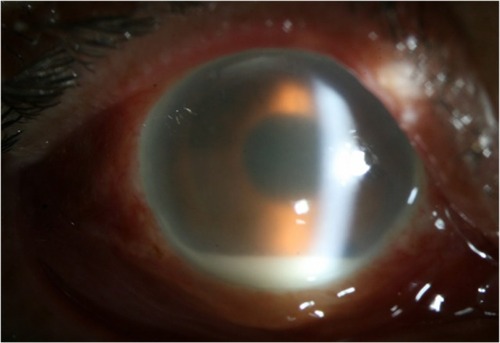 Figure 1 Right eye shows conjunctival injection, corneal edema with infiltrates at the superior corneal incision site, membrane formation around the IOL and a 2 mm hypopyon.