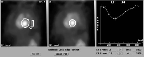 Figure 2.  MUltiple Gated Acquisition (MUGA) scan showing left ventricular ejection fraction (LVEF), end-diastolic (ED) diameter and end-systolic (ES) diameter 1 year after the start of sunitinib treatment when cardiac symptoms appeared.