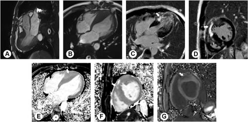 Figure 3 Images of a 34-year-old man with hypertrophic cardiomyopathy. Cine-magnetic resonance imaging in the three-chamber (A) and four-chamber (B) view showing hypertrophy of the interventricular septum and apex. The maximum septal wall thickness was 27 mm, and the left ventricular ejection fraction was 50% in this patient. Extensive myocardial late gadolinium enhancement (C and D) was found at the mid-wall layer from the anterior region to the inferior septum (arrows), with apex involvement, which was hyperintense as compared to the blood. Native T1 maps in the LV mid-chamber short-axis and four-chamber view (E and F) showed patchy areas of increased T1 relaxation (arrows) in the septum, which was more marked in hypertrophic segments. Post-contrast T1 map (G) showed patchy areas of decreased T1 relaxation (arrows) in the septum. Gray scale range: 0‒2000 ms.