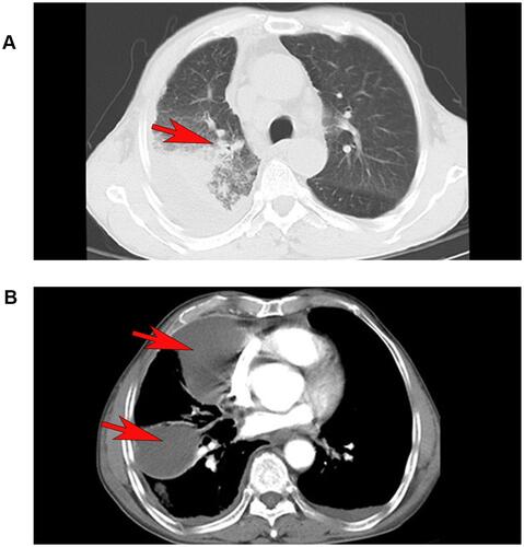 Figure 1 First lung CT scan, slight exudation, interstitial changes, and atelectasis in the upper lobe of the right lung, a medial segment of the medial lobe of the right lung, and the lower lobe of the right lung pointed by the red arrows (A). After 7 days of antibiotic treatment, multilocular encapsulating pleural effusion in the right upper and middle leaves pointed by the red arrows (B).