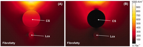 Figure 6. Current density around CS for cases without balloon (A) and with air balloon (B). Note that electrical current is drastically distorted by the presence of the balloon. The current goes through the CS in the case without a balloon, whereas it surrounds the CS when an air-filled balloon is placed inside it.