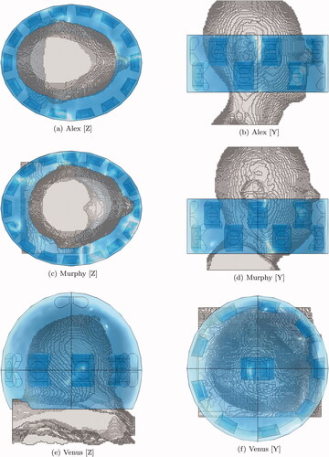 Figure 1. Schematic of the patient models and the applicator. The water bolus is shown in blue. The patient model is shown in gray. (a) and (b) show the 14-channel two-row cylindrical applicator for Alex. (c) and (d) show the 16-channel two-row cylindrical applicator for Murphy. (e) and (f) show the 10-channel spherical applicator for Venus.