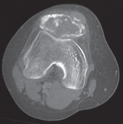 Figure 2. Computed tomography showing an intraosseous osteolytic lesion and soft tissue extension at the anterior part to the patella.