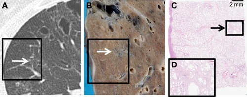 Figure 4 Computed tomography images and their corresponding histological images of right upper lobe.Notes: (A) Computed tomography image shows subtle fine reticulation (arrow) which can be identified with careful observations. (B) A gross picture of the same area. (C) Microscopic observation of squared area in (A, B). (D) Close-up of the squared area in (C) revealed significant interstitial fibrosis.
