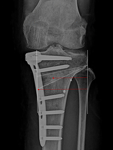 Figure 3 The result of (Line A/ Line B) × 100 was the rate of osteotomy gap union.