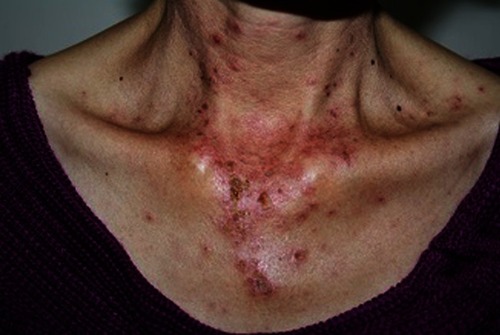 Figure 1 Acute cutaneous lupus erythematosus–associated vesiculobullous disease. A few vesicles and erosions arising on erythematous edematous maculopapular patches in a V shape on the neck.