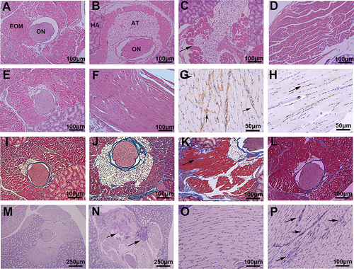 Figure 4 Histologic Features of the orbit from hTSHR A-Subunit Plasmid Immunized Mouse. The entire orbital tissues (including orbital bone) were fixed, decalcified, paraffin embedded and consecutive sections centered on the optic nerve were subjected to different staining procedures. (A) HE stain of orbit from control mice (x100). (B–D) HE stain of orbit from TSHR mice (x100). (B) Adipose tissue production increased. (C) Expansion of adipose tissue in retrobulbar fat (arrowed). (D) Muscle fibers were disturbed and the Intermuscular widened. (E and F) HE stain of orbit from TSHR-immunized mice treated by TSG-6 (x100). Lipogenesis and extraocular muscle hypertrophy were improved compared with the untreated group. (G) Immune histologically CD3 stained of EOM from TSHR mice (x200). Intense intermuscular T-lymphocytic infiltrate (arrowhead). (H) Immune histologically CD3 stained of EOM from TSG-6 treated mice (x200) indicates the reduction of inflammatory infiltration. (I–L) Masson stain (x100). Collagen fibers were dyed blue. Compared with the control group (I), the collagen fibers in the TSHR group (J and K) were increased, and the muscle fibers were separated by it (K, arrowhead). But the TSG-6 treatment group (L) relieved. (M and N) Periodic Acid-Schiff stain (x40). (O and P) Periodic Acid-Schiff stain (x100). Mucopolysaccharide substances in tissues appear purplish-red. Compared with the control group (M and O), the extracellular matrix accumulation in the TSHR group (N and P) increased (arrowhead).