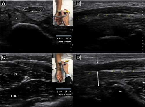 Figure 3 Normal median nerve and flexor tendons (*) in cross section (A) and longitudinal view (B). Normal median nerve in the forearm (C) superficial to flexor digitorum profundus (FDP) and deep to flexor digitorum superficialis (FDS) muscles. Abnormal median nerve at the wrist (D) with hourglass constriction (white arrows) with swelling proximally at the carpal tunnel entrance (**).