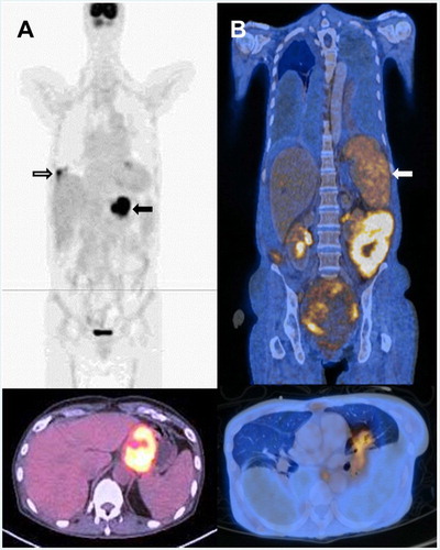 Figure 3. Involvement of extra-intestinal sites on presentation and relapse. (A) Patient 10 on presentation. Upper panel: hypermetabolic primary lesions in distal oesophagus and stomach (arrow). There was another metabolically active lesion in the lower lobe of right lung (open arrow). Lower panel: axial image showing hypermetabolic lesion in distal oesophagus and proximal stomach. (B) Patient 7 with primary lesion involving small bowel, and relapse involving other anatomical sites but not the small bowel. Upper panel: coronal image, showing involvement of the spleen (arrow). Lower panel: axial image showing hypermetabolic lesion in the left lung.