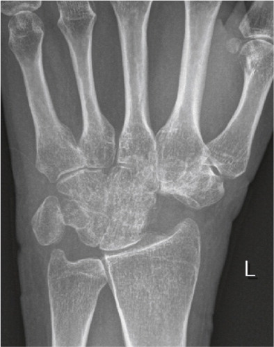 Figure 5. Four-corner fusion after SNAC 3 arthrosis. Follow-up frontal radiograph after 3 years.