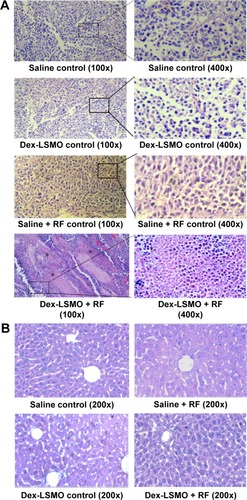 Figure 5 Effect of RF induced Dex-LSMO nanoparticles-mediated hyperthermia treatment on tumor histology.Notes: Photomicrographs of HE-stained (A) tumor sections and (B) liver sections from untreated controls and Dex-LSMO + RF-treated mice on Day 8 of treatment. Asterisks show necrotic area.Abbreviations: HE, hematoxylin and eosin; Dex-LSMO, dextran-coated lanthanum strontium manganese oxide; RF, radiofrequency.
