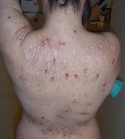 Figure 2 Morgellons patient’s back. Note that lesions and scars occur in areas that could not have been reached by the patient. Photo courtesy of Cindy Casey, Charles E Holman Foundation, Austin, Texas. Reproduced with permission.
