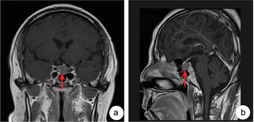 Figure 1. Enhanced MRI of the saddle region displayed a cystic lesion within the sella (red arrow indication) 12 × 12 × 18 mm. A:Coronal plane; B:Sagittal plane.