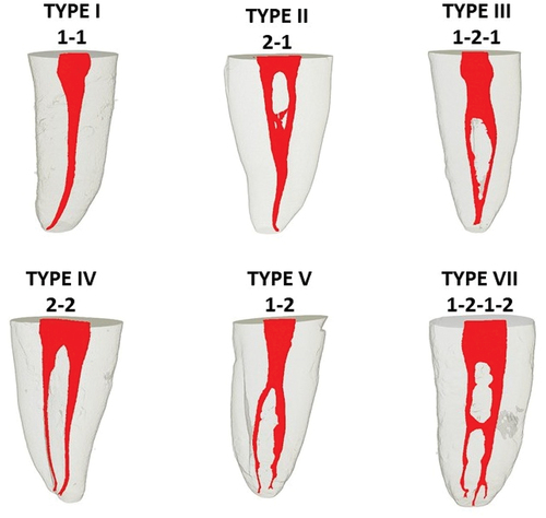 Figure 2. Vertucci’s classification by micro ct observed in mandibular premolars.