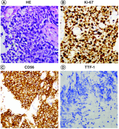 Figure 2. HE and immunohistochemistry staining of tumor.HE: hematoxylin-eosin; TTF-1: thyroid transcription factor-1. All images were shown at 400×.