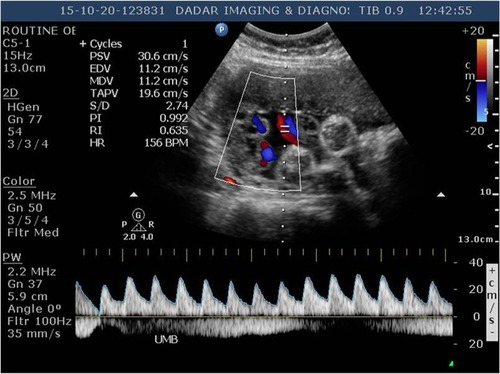 Figure 6 Doppler of umbilical artery showing normalization of systolic/diastolic ratio (2.74) after starting sildenafil citrate.