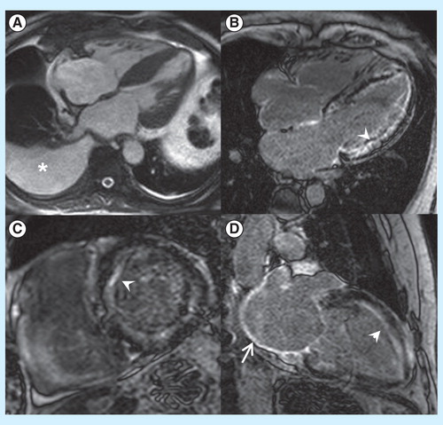 Figure 1. Typical features of CA with CMR. Characteristic concentric increase in left ventricular wall thickness can be noted in a four-chamber cine view (Panel A) together with pleural effusion (asterisk). Post-contrast LGE sequences (Panels B to D) demonstrate diffuse, predominantly subendocardial enhancement (arrowheads). Panel D also shows hyperenhancement of the left atrial wall (arrow), suggestive of amyloid infiltration of atrial myocardium.