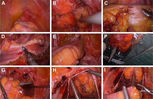 Figure 4 Transanal specimen extraction via laparoscopic rectectomy without an abdominal incision.