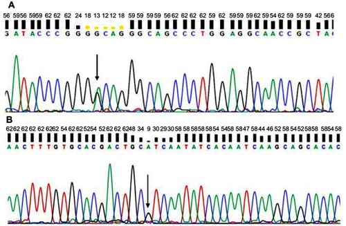 Figure 3 Sequencing data of patient with PRNP. (A) G40 and (B) V180I.Note: Arrows indicate mutation. 