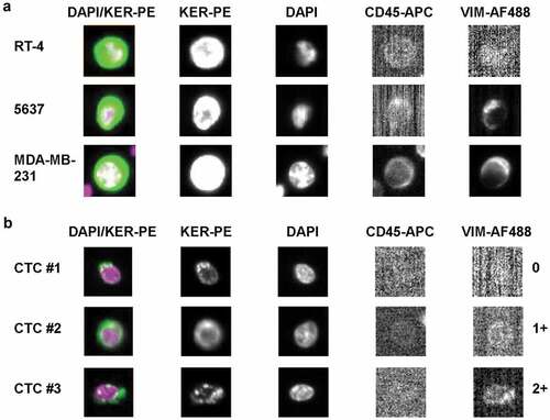 Figure 4. CellSearch® CTC kit analysis of vimentin expression. Cells were enriched by anti-EpCAM magnetic beads using the CTC kit. Keratin+ (KER-PE), CD45- (CD45-APC), DAPI+ cells were identified as tumor cells. Vimentin expression of (a) RT-4, 5637 and MDA-MB-231 cells and of (b) CTCs detected in the blood of advanced UC patients was analyzed by the AlexaFluor488-conjugated anti-vimentin antibody clone V9 (VIM-AF488). Images of vimentin-specific fluorescent signals were generated using an exposure time of 0.8 sec. Vimentin expression of individual CTCs was categorized into negative (0), weakly positive (1+) and moderately positive (2+).