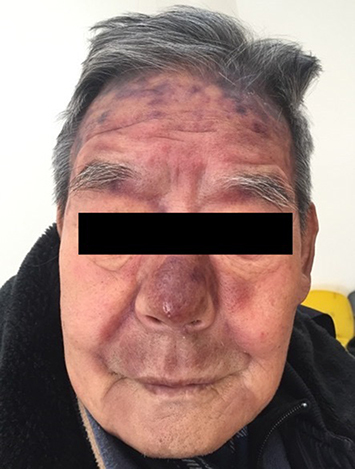 Figure 1 Violaceous infiltrated plaques on his face.