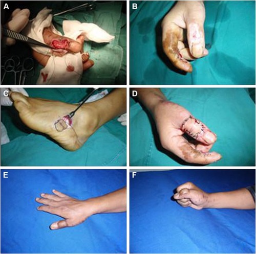 Figure 3 Electrical injury to the right thumb treated with the free LTA flap (Case 2).