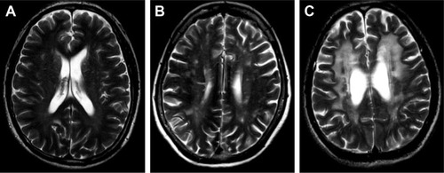 Figure 2 Different scores of D-WMH.