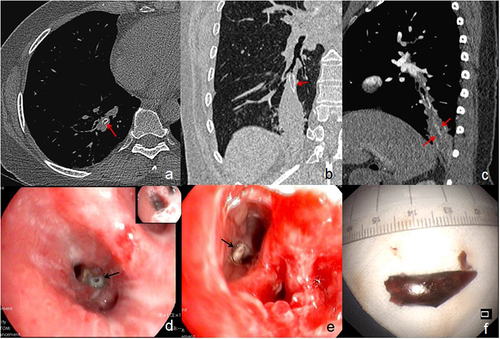 Figure 2 A 56-year-old woman with cough and expectoration for 2 years and no definite history of pepper aspiration. Axial (a) and coronal (b) CT images show annular (red arrow) and V-shaped (red arrow) high density in the outer basal segment bronchus of the right lower lobe and atelectasis. Sagittal enhanced CT image shows the thickened bronchial wall adjacent to foreign body and bronchiectasis with mucus plugs (arrows) in atelectasis (c). Bronchoscopy examination shows purulent secretion (d, arrow) and white foreign body (e, arrow) in the opening of the bronchus. Finally, the foreign body is revealed as pepper shell (f).
