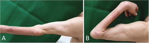 Figure 3. Case 1: Range of motion in the forearm and elbow 8 years and 3 months after the operation. (A) Degree of extension. (B) Degree of flexion.