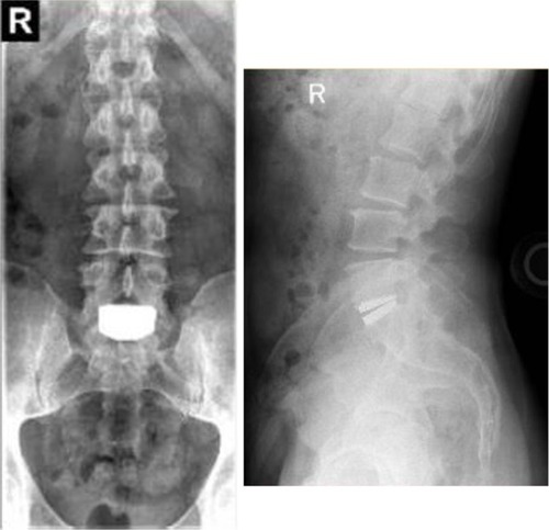 Figure 8 Anterioposterior (left) and lateral (right) radiographs 7 years following implant with the activL® Artificial Disc.